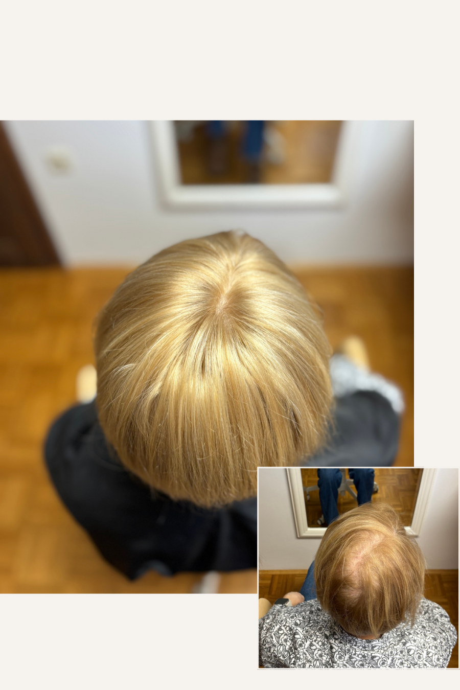 kratek lasni vložek iz naravnih las, hormonsko izpadanje las