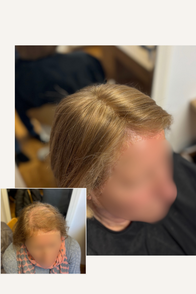 tanka lasje po celotni glavi izpadanje las, naraven lasni vložek iz evropskih las