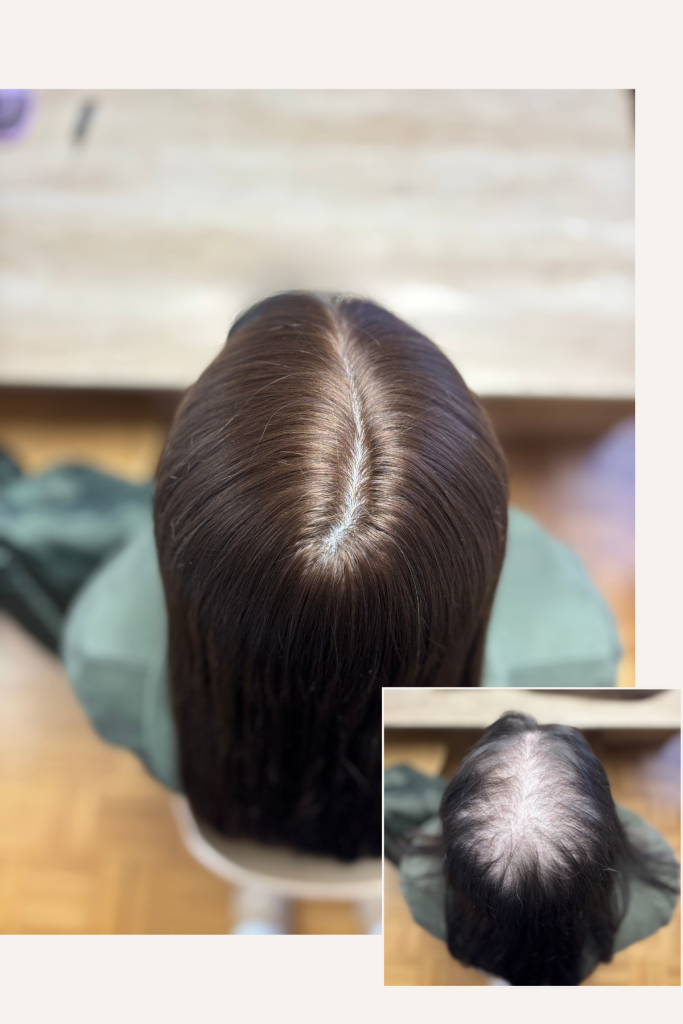 izpadanje las na temenu, lasni vložek iz naravnnih las kot naravna rešitev